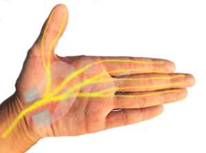 Physiotherapy Carpal Tunnel Decompression leaflet